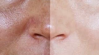 Ci̇lt Lekeleri̇çi̇llerci̇ltte Sert Ur-Bezevücut Peeli̇ngi̇
