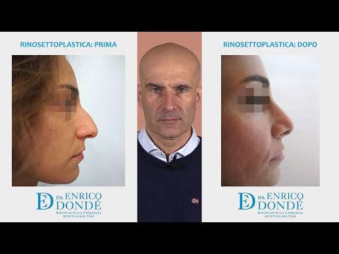 Rinosettoplastica prima e