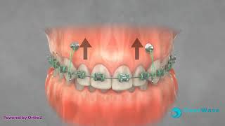 Tads For Gummy Smile