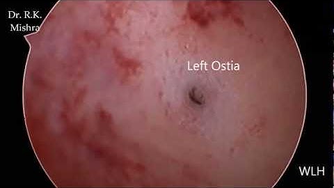 Diagnostic Hysteroscopy by Dr. R.K. Mishra