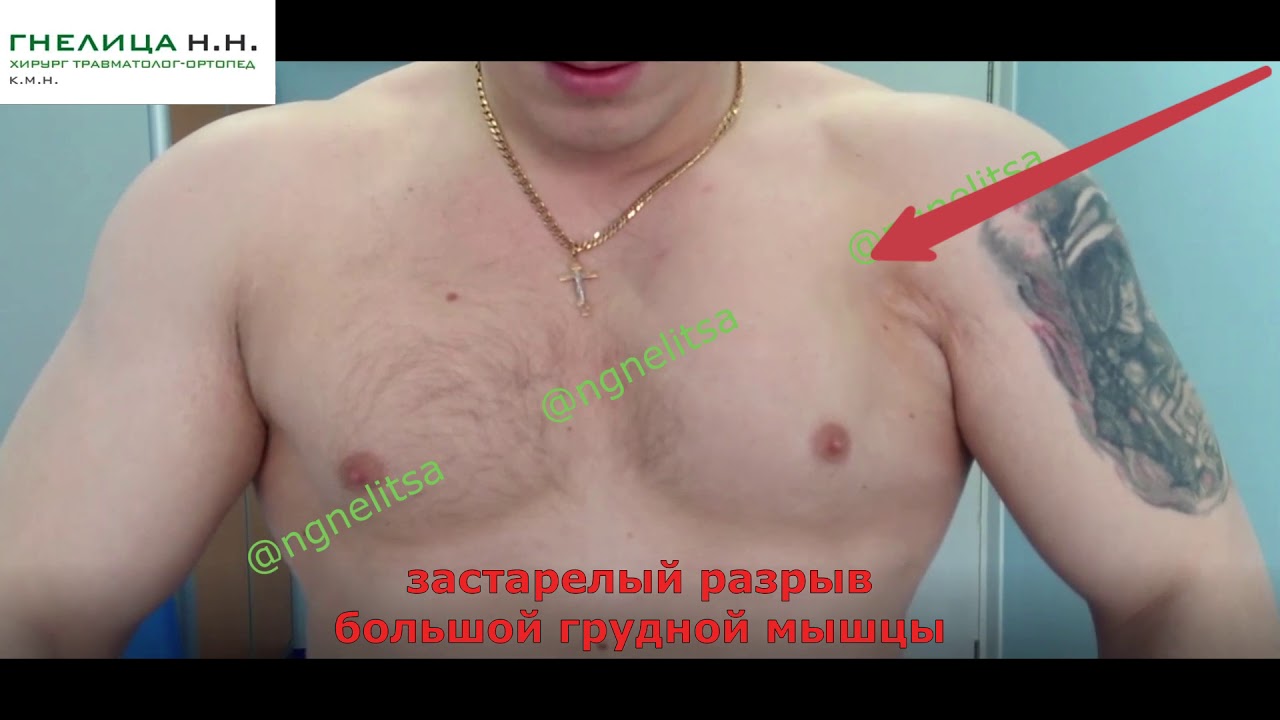 лечение застарелого разрыва большой грудной мышцы - опыт и уникальная ...