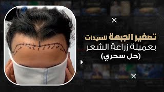 تصغير الجبهة للسيدات عن طريق زراعة الشعر (حل سحري) د. شريف حجازي