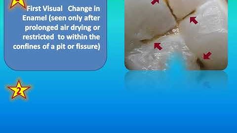 International Caries Detection and Assessment System (ICDAS)