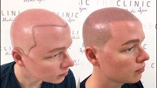 Alopecia SMP micro haar pigmentatie Amsterdam