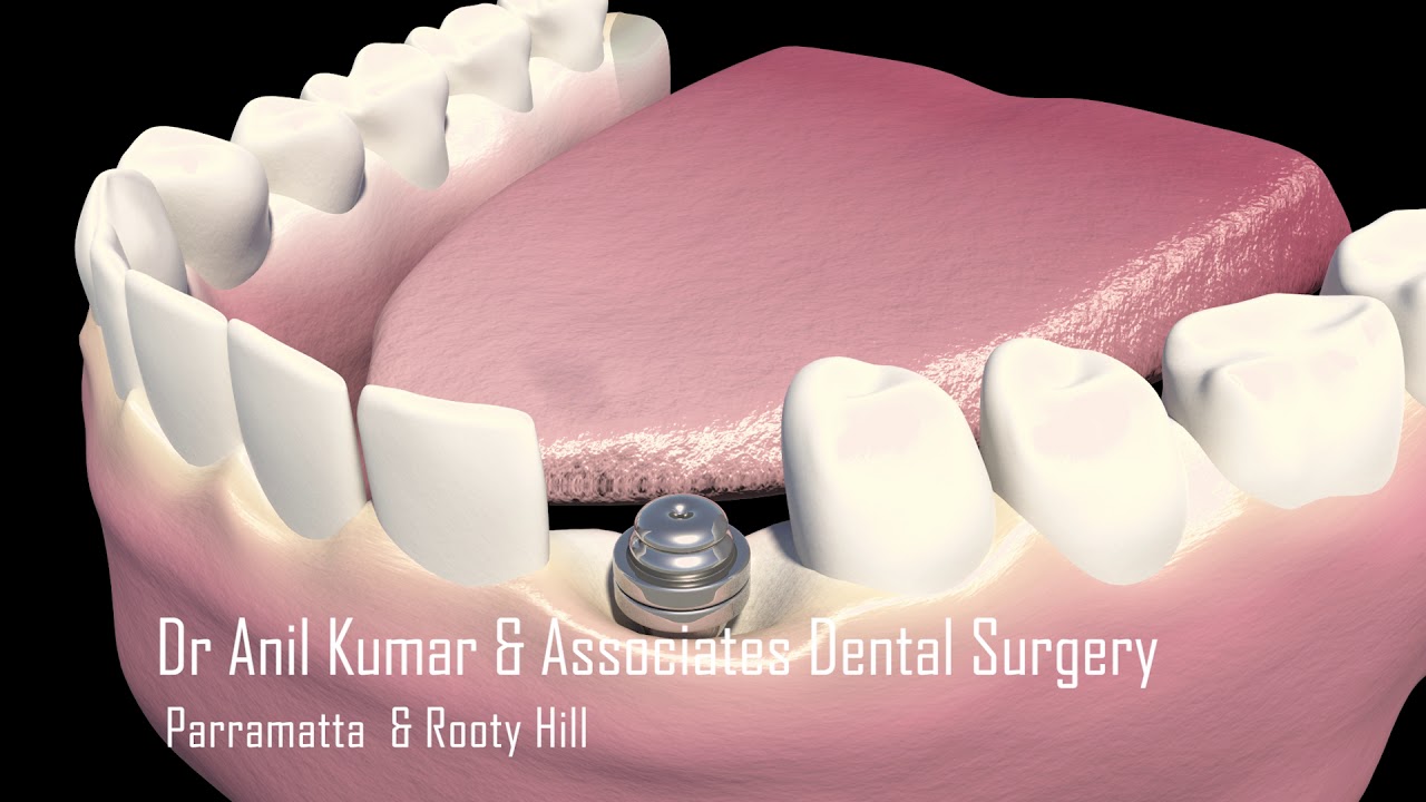 Dental Implant YouTube