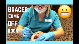 19th Braces Visit || Almost Done With Phase 1