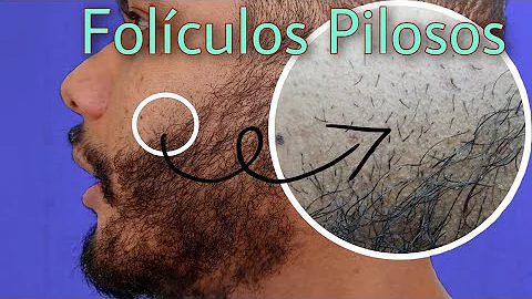 Como saber se eu tenho Foliculos na barba?