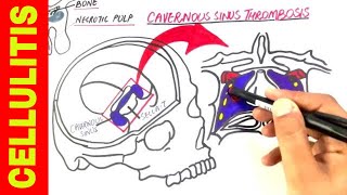 CELLULITIS | The Silent Killer! screenshot 1