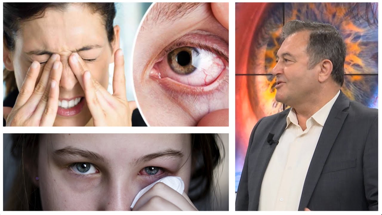 Kurat popullore për alergjitë e syve / Ylli Merja tregon 'sekretin'... ja si të shpëtoni në pak ditë