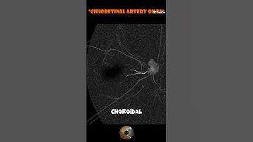 TIP#2 - Cilioretinal Artery On FFA