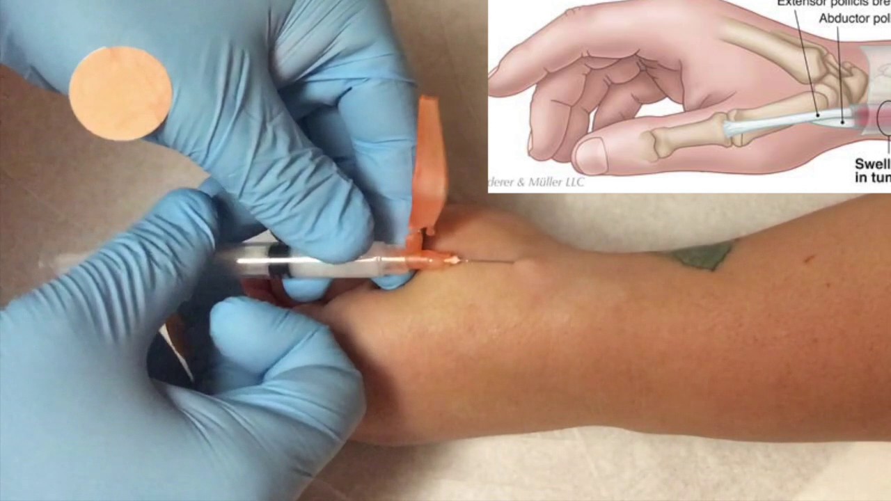 de quervain syndrome injection hogyan kezeljük az ízületi gyulladás fájdalmait