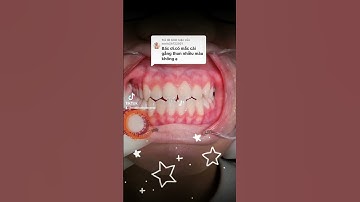 thun nhiều màu trong niềng răng mắc cài. #trending #dentist #makeup #niengrangtragop