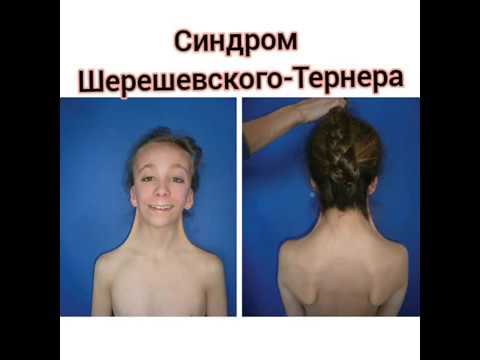 Синдром Шерешевского-Тернера. Причины патологии, диагностика, лечение.