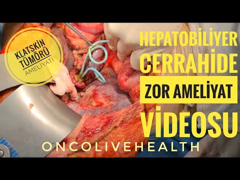 HEPATOBİLİYER CERRAHİDE ZOR AMELİYAT VİDEOSU | KLATSKİN TÜMÖRÜ AMELİYATI profdrunalaydın