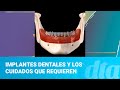 Implantes dentales y los cuidados que requieren