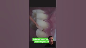 Veneers cementation for smile makeover#Veneers #SmileMakeover #beforeandafter#cosmeticdentistry