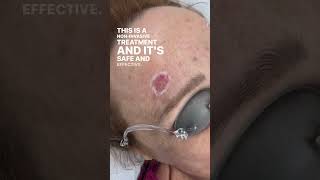🌟 Pigmentation Removal with nd:YAG Laser 🌟