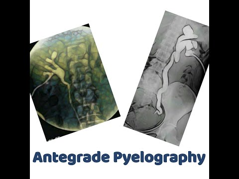 antegrade Pyelography