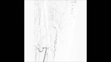 DISTAL SFA CTO treated with SMART stent