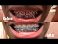FULL BRACES JOURNEY: 1 & 1/2 YEARS (GAPS, SMALL OVERBITE, CHAINS AND OVERALL EXPERIENCE)