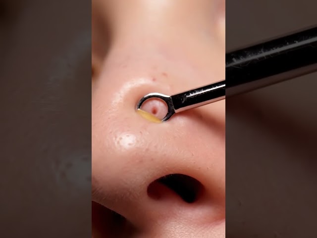 “Oddly Satisfying Blackhead Extraction Compilation”