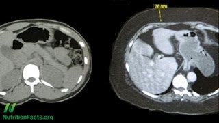 Metabolic Syndrome and Plant-Based Diets