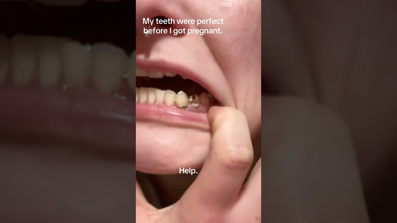 Does Pregnancy Cause Your Teeth To ROT?! 🦷🤰