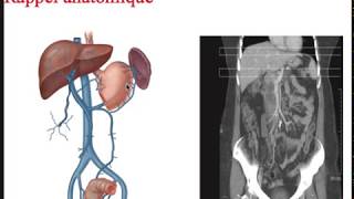 FMPM MOOCs - Les abcès hépatiques - Pr. Rabbani