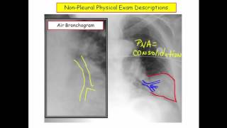12DaysinMarch, Pleural Disorders for USMLE Step One