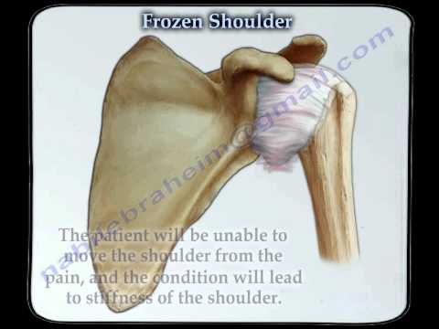 Frozen Shoulder - Everything You Need To Know - Dr. Nabil Ebraheim