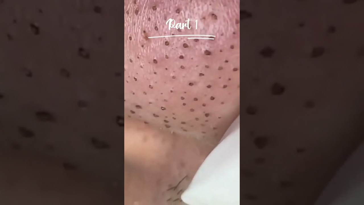 Blackhead & sebaceous filaments extractions #shorts #skincare