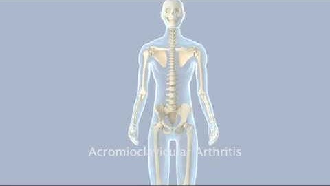 Acromioclavicular Arthritis