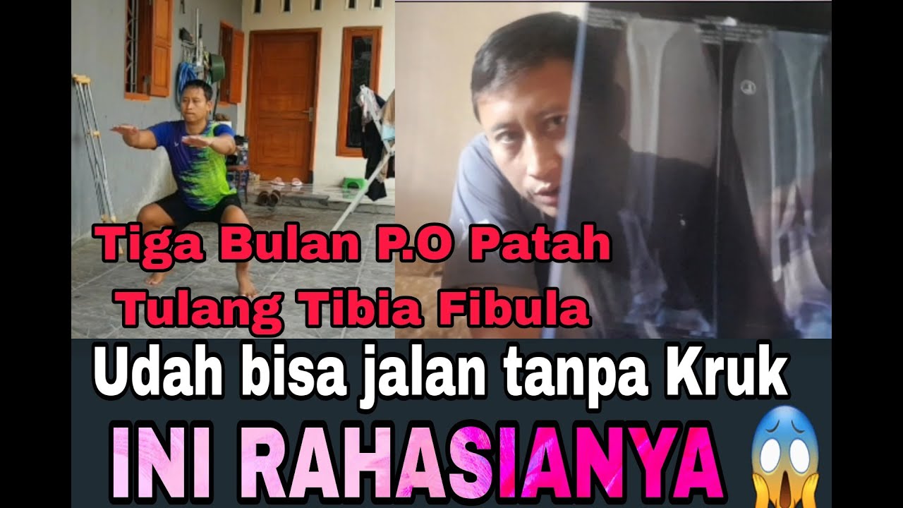 Latian jalan P.O 3 bulan Patah Tulang Fraktur Tibia Fibula