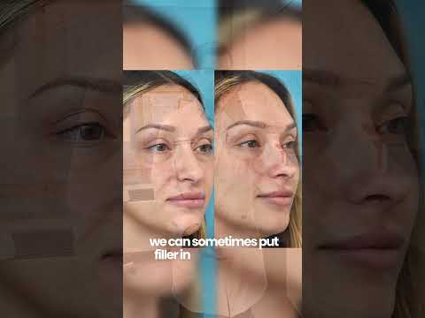 Video thumbnail: Refinement with Non-Surgical Rhinoplasty 💉👃 | Dr. Kirk Lozada · Becker Aesthetics & Plastic Surgery