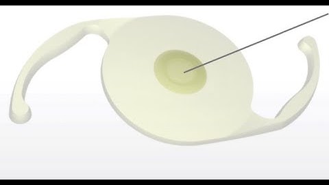 Vivity Toric IOL implantation