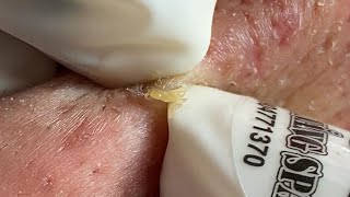 Huong Da Nang Acne Treatment #345