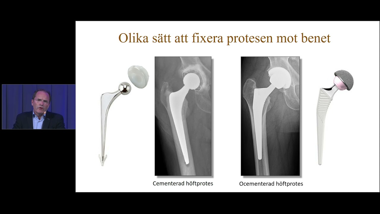 När är det behov för protesoperation? (Webinar: När minnet sviktar eller leder gör ont)