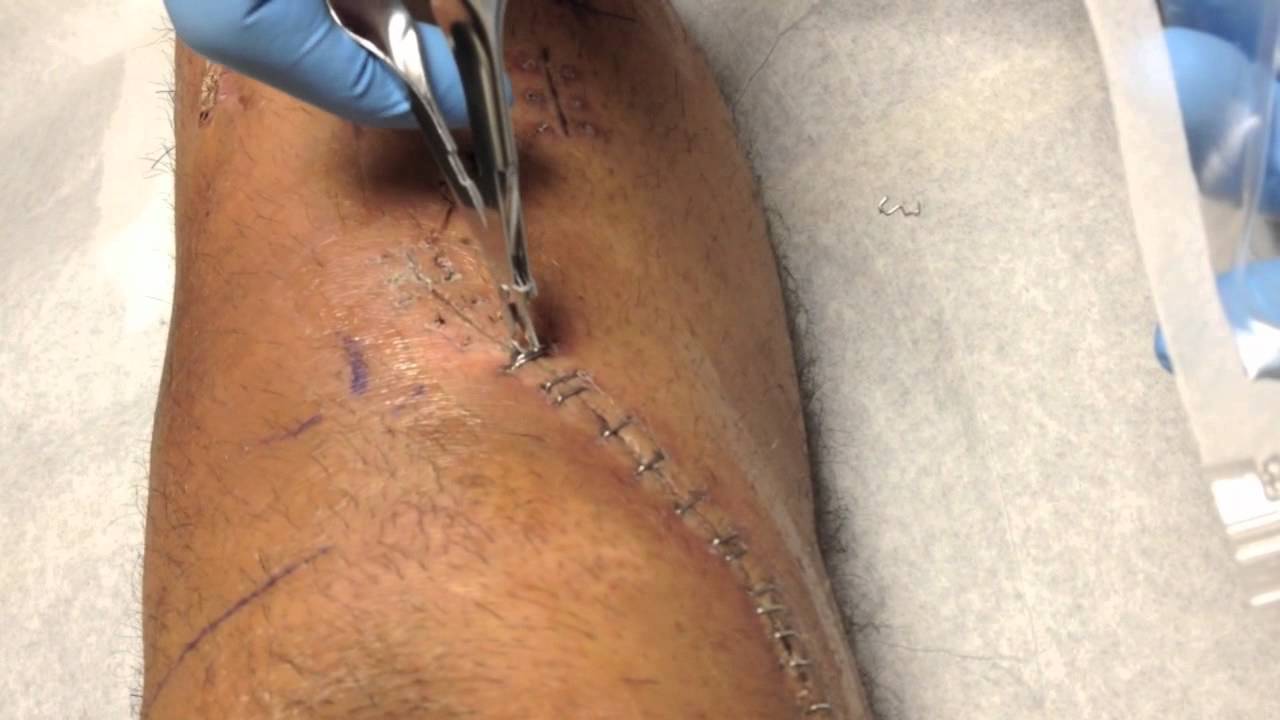 Will it hurt when my stitches are removed after surgery? (Video)