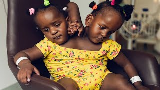 20 Extraordinary And Eye Opening Facts About Conjoined Twins