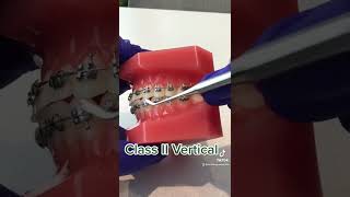 Class II Vertical Rubber Bands