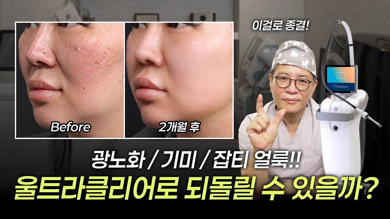 광노화, 기미/잡티/얼룩! 울트라클리어로 되돌릴 수 있을까?