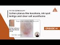 Fit for Dermoscopy Episode 14 - Lichen planus-like keratosis, ink spot lentigo &amp;clear cell acanthoma