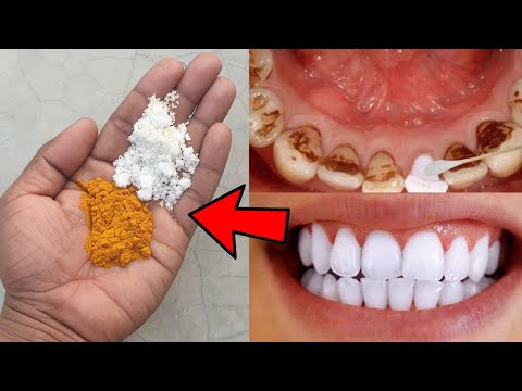 सिर्फ 2 मिनट में पिले गंदे दांतों को मोती की तरह चमका देगा ये नुस्खा | Teeth Whitening Home Remedy