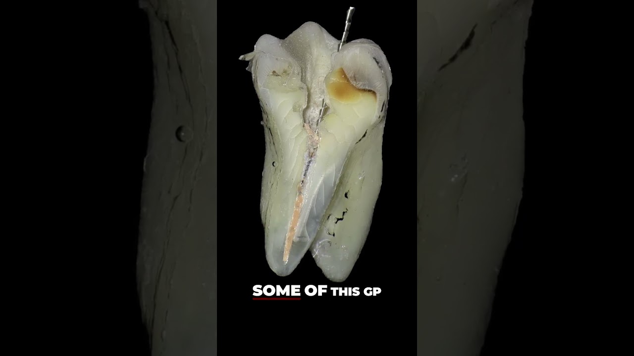 Упорная закупорка корневого канала. Посмотрите этот лайфхак с зондом!