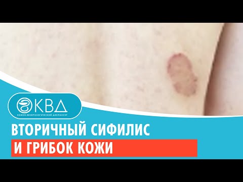 Вторичный сифилис и грибок кожи. Клинический случай №47