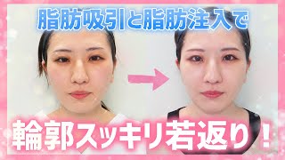 若返り Kunoクリニック 顔の脂肪吸引脂肪注入 施術レポート 脂肪注入 Youtube