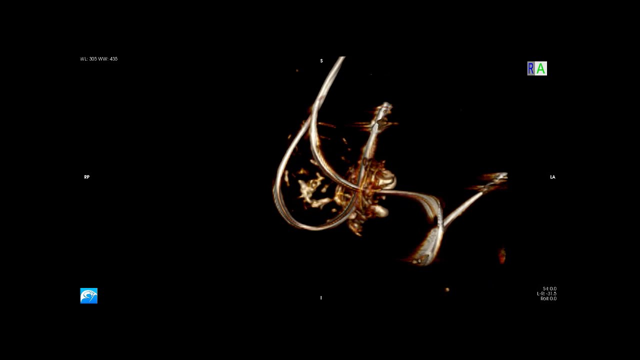 Combined Mitral and Tricuspid Valve-in-Valve Via Transapical Approach
