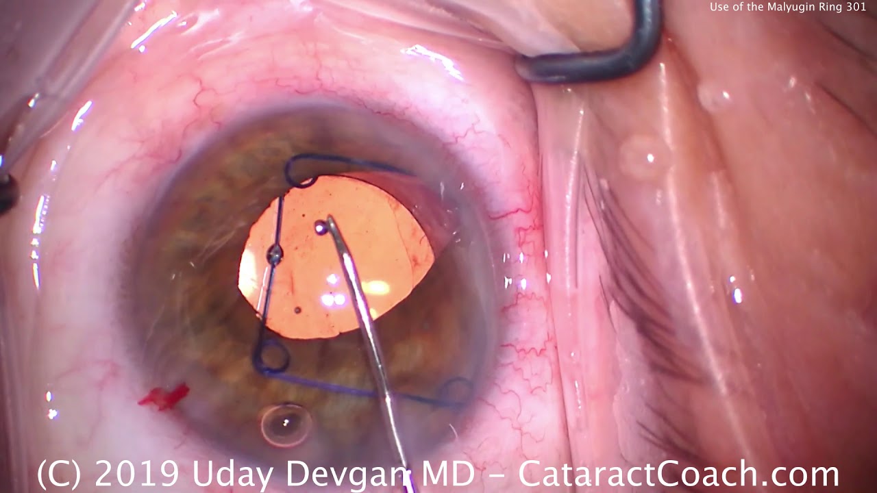 Phacoemulsification: Malyugin Ring Insertion and Removal - YouTube