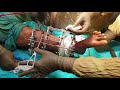 Corticotomy limb lengthening  ilizarov