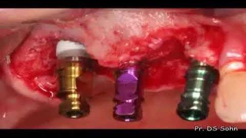 Sinus augmentation using HPISE and Ridge Augmentation